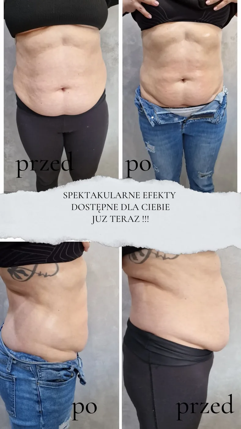 Efekty zabiegu na brzuchu — przed i po